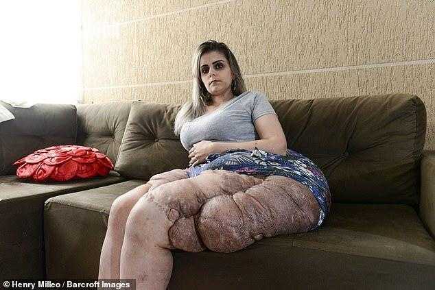 28岁女子大腿和臀部挂着80斤肿瘤 手术后仍疯长