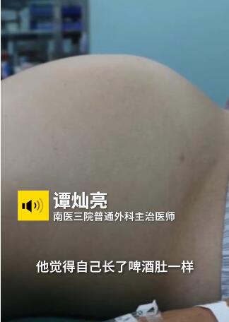广州一小伙肚子胀认为是“啤酒肚”，到病院便诊后医生从肚子里取出的物品把他吓一跳。