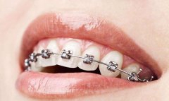 改正牙齿对于以来有作用吗?改正牙齿利与弊有哪些?