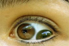 人类5种常睹的瞳孔 个中没有少瞳孔瞅起来十分恐惧
